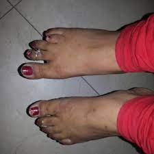 Pdf Brachymetatarsia With Accessory Navicular In Right Foot A Rare Coincidental Finding