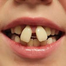 You can order a $95 starter kit to take impressions of your teeth at home. Patient Warning Do Not Attempt Diy Teeth Straightening California Association Of Orthodontists