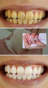 Blanquea Tus Dientes Amarillos Con Esta Poderosa Receta Con Imagenes Limpieza Dientes Blanqueador De Dientes Blanqueamiento De Dientes