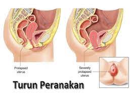 Peranakan jatuh boleh disebabkan oleh punca seperti bersalin normal dan obesiti. Cara Mengatasi Peranakan Turun Prolapsus Uteri Luvizhea