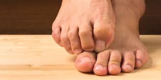 Commonly asked questions about bunion bootie. Overlapping Toes The Complete Guide Vive Health