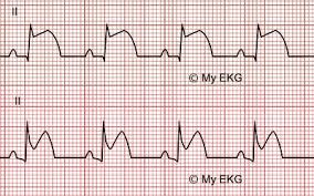 O enfarte agudo do miocárdio, conhecido como ataque cardíaco, ocorre quando uma artéria fica obstruída por um coágulo. Infarto Agudo Com Elevacao Do Segmento St No Eletrocardiograma