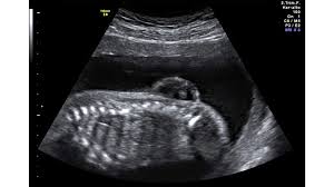 Laut tagebuch hätte ich theoretisch meine periode am 14. Offener Rucken Spina Bifida Beim Baby Was Bedeutet Das Hallo Eltern