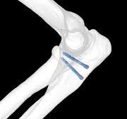 REDUCT – Headless Compression Screws - LEDA