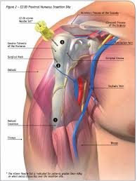 Image result for Intraosseous Access