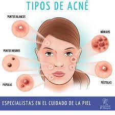 Hay que evitar tocarlos y es preferible no exprimirlos para evitar el ingreso de bacterias en la piel y en el torrente sanguíneo que pueden provocar diferentes enfermedades de. Control Acne Cuales Son Los Diferentes Tipos De Granos De Acne Puntos Blancos Son Muy Pequenos Y Generalmente Estan Presentes Debajo De La Piel Espinillas Las Espinillas Se Pueden Ver Claramente