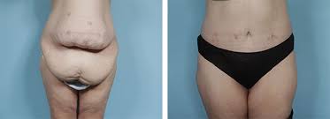 How much is body contouring. Body Contouring Surgery Chicago Body Lift Dr Kim