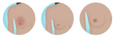 These tubes, which are hollow, allow lymph fluid to drain out of the breast. Inflammatory Breast Cancer Symptoms Diagnosis Treatment National Breast Cancer Foundation