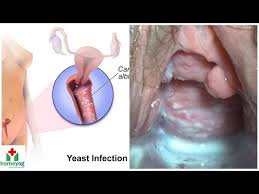 Image result for vaginal thrushsymptoms