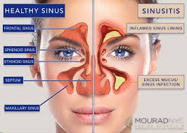 Image result for Sinus Surgery