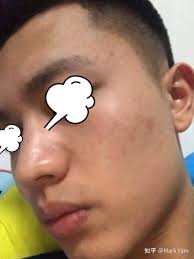 有什么方法可以完全祛痘（一点痘痘不剩的那种）？