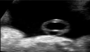 Ultrasonographic Soft Markers Of Aneuploidy In Second Trimester Fetuses Sciencedirect