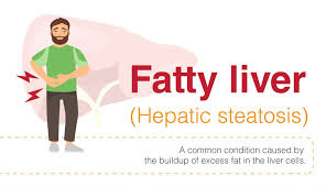 Most people don't have signs and symptoms in the early stages of primary liver cancer. Overview Of Fatty Liver Signs Symptoms And Diagnosis