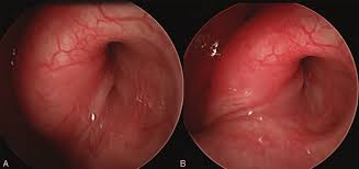 Image result for Eustachian Tube Dysfunction