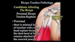 Biceps tendonitis , also called bicipital tendonitis , is inflammation in the main tendon that attaches the top of the biceps muscle to the shoulder. Biceps Tendon Pathology Everything You Need To Know Dr Nabil Ebraheim Youtube