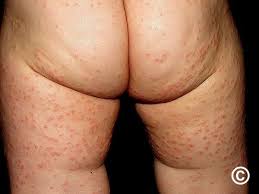 Image result for Papular Acrodermatitis