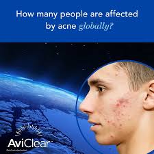 My Battle with Adult Acne: How Aviclear Laser is Providing a Lasting  Solution