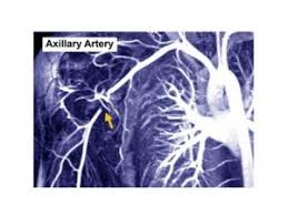 Arterial Thoracic Outlet Syndrome Tos Center For Thoracic Outlet Syndrome