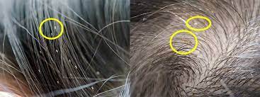 Maybe you would like to learn more about one of these? How To Check Yourself For Lice Licefreee