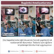 Goz Kapaklarinda Sigil Skuamoz Hucreli Papillom Sik Rastlanan Bir Durumdur Tedavisi Icin Sigillere Kriyoterapi Dondurma Uyguluyoruz Bilgi Gozler Tintin