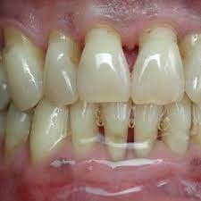 Although there aren't any studies proving tooth bone loss is reversible naturally, proper dental care, attention to your health and supplementation can help prevent it and slow it down. Dental Bone Loss Causes Bone Loss Dental Bone Loss In Teeth