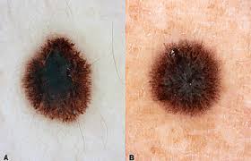 Skin cancers usually present as an abnormal growth on the skin. 5 Signs Your Child S Mole Needs To Be Checked