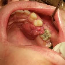 Image result for granuloma gum disease