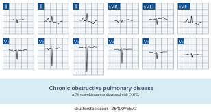 Image result for Right Axis Deviation
