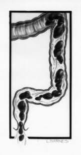 Image result for Functional Encopresis