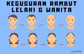 Punca rambut gugur di usia muda. 6 Punca Rambut Gugur Hello Doktor