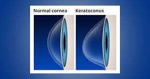 Research suggests keratoconus may be due to an imbalance of enzymes within the cornea. 10 Keratoconus Treatments Plus Causes Symptoms