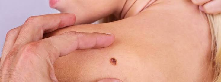 What to Know About Skin Cancer - Live Better | Revere Health