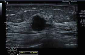 Mammograms are the best breast cancer screening tests we have at this time. Images Of Breast Cancer A Mammogram Showing An Irregular High Density Download Scientific Diagram