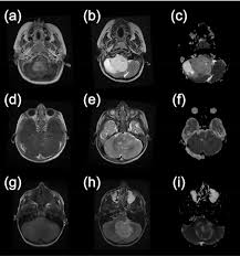 Go to the emergency room if a child develops any of. Child Brain Tumors Can Be Classified By Advanced Imaging And Ai Imaging Technology News