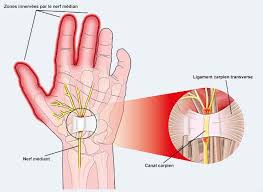 En dehors d'une fracture de la main, la douleur à cet emplacement nécessite des investigations. Epingle Sur Faire De L Exercice