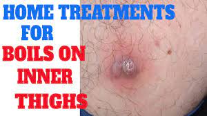Home Remedies To Get Rid Of Boils On Inner Thighs | Treatments For Boils On  Skin | Boils On Buttocks - Youtube