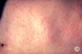 Image result for skin rash acute hiv infection
