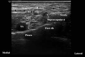 Image result for Superior Trunk Block