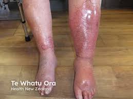 Image result for Cellulitis