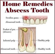 Pin By Beth Mcadoo On Abscesses Tooth Help Home Health Remedies Home Health Remedies