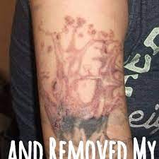 The chemical solutions use the body's natural processes to remove tattoos. My Experience Lightening And Removing My Tattoo At Home Tatring
