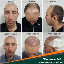 Dr Zen Hair Clinic Olcay Saygin 2020