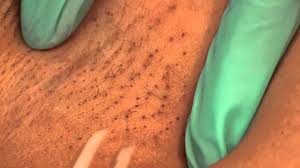 What are ingrown hairs, other than painful, unsightly nuisances? Tweezing The Underarms Waxing Tweezing Youtube