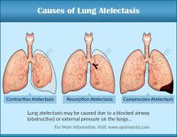 Causes Of Lung Atelectasis Emergency Nursing Medical School Studying Respiratory Therapy