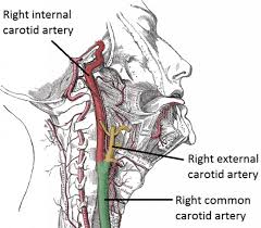 The vertebral arterie s stem from the subclavian arteries; Carotid Artery Disease Clinical Features Management Teachmesurgery