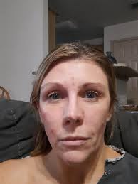 Beach photography as back surgery rehab