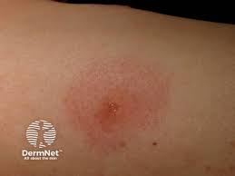 Image result for Papular urticaria
