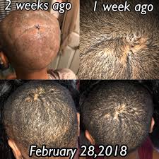 A partial or full weave is sewn into tight braids of your own hair. Wtf See How This Woman S 2 Month Old Weave Caused Her Go Bald Beauty Style Bet