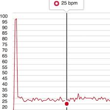 This French Biathletes 25 Bpm Resting Heart Rate Is So Low