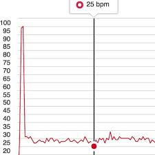 this french biathletes 25 bpm resting heart rate is so low